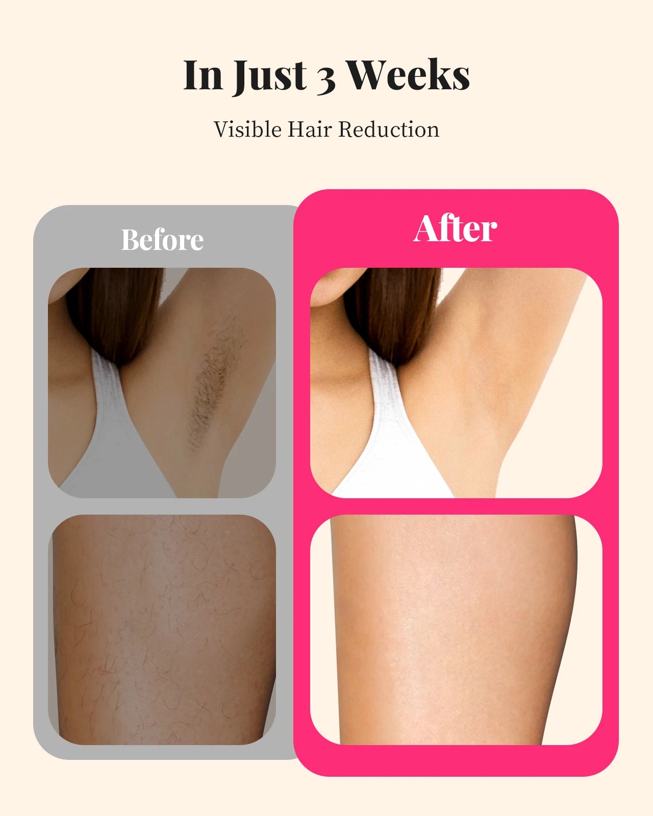 Totmizby IPL Laser Hair Removal Device For Body And Face